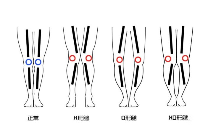 1,正常腿型